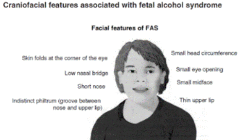 Facts about FASD