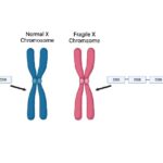 Fragile X Chromosomal Differences